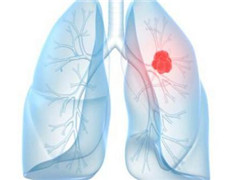阿法替尼治疗肺鳞癌的效果怎么样？