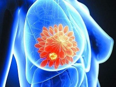 乳腺癌是怎么得的