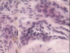 转移性黑色素瘤使用达拉非尼的效果和副作用