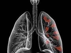 FDA认证布加替尼成为肺癌突破性疗法