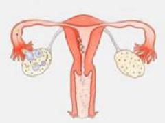 卵巢癌患者可以在尼拉帕尼中受益吗 