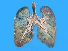 肺纤维化患者能够使用尼达尼布吗？