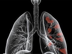 克唑替尼可使部分肺癌患者达到完全缓解。