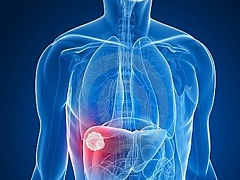 索拉非尼可以预防肝癌复发吗？
