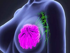 乳腺癌的辅助治疗药物帕妥珠单抗