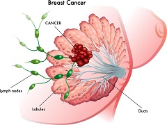 帕妥珠单抗获得了晚期乳腺癌的NICE批准