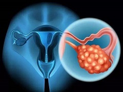 尼拉帕尼批准用于3种类型的妇科癌症 