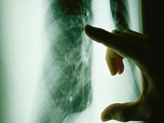 使用尼达尼布作为肺腺癌二线治疗效果好吗？