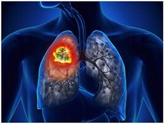 非小细胞肺癌也能够通过凡德他尼来治疗？