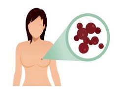 奥拉帕尼失效后乳腺癌患者也可以保持现状。