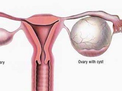 尼拉帕尼批准用于卵巢癌维持治疗