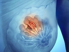 帕博西尼对乳腺癌患者帮助大吗？