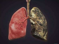 肺癌患者能否使用艾乐替尼长期治疗