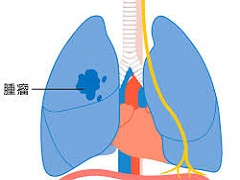 克唑替尼治疗肺癌的效果与化疗相比怎么样呢？