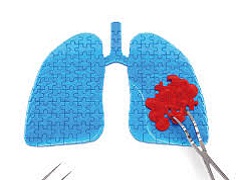 克唑替尼可以针对性查杀肺癌细胞！