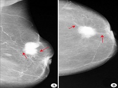帕博西尼是否能显著改善乳腺癌患者症状