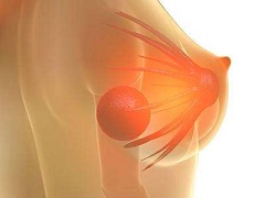 帕妥珠单抗三联疗法对HER2阳性乳腺癌的治疗  