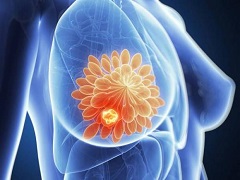 来那替尼扩展辅助治疗HER2乳腺癌存在副作用