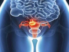 卵巢癌患者服用奥拉帕尼出现腹泻应如何解决？