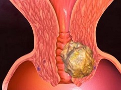 奥拉帕尼可用于化疗后的卵巢癌患者！