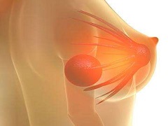 帕妥珠单抗对HER2过表达的乳腺癌患者有治疗效果