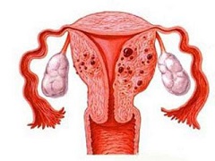 延缓复发性卵巢癌的进展能够使用尼拉帕尼