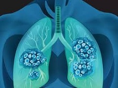 派姆单抗联合伊匹单抗治疗肺癌的效果怎么样？