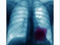 吉非替尼与阿法替尼治疗肺癌哪个更有效？