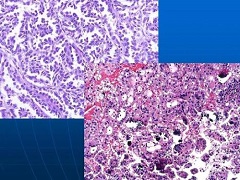 乐伐替尼是治疗晚期肝癌的潜在突破？