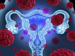 奥拉帕尼能否使卵巢癌患者长期获益？