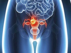 奥拉帕尼可以治疗BRCA突变的晚期卵巢癌