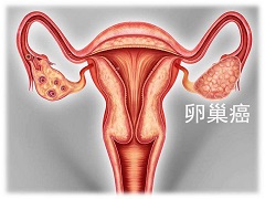 奥拉帕尼单药治疗晚期复发性卵巢癌