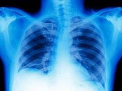 凡德他尼可以联合治疗非小细胞肺癌