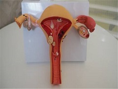导致女性卵巢癌的几大因素