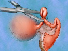 卵巢癌患者能用帕唑帕尼来维持治疗吗？