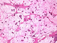 高龄乳腺癌患者依旧可以通过帕博西尼来治疗
