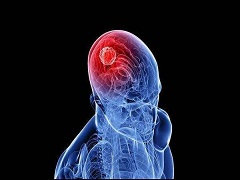脑肿瘤剧烈头痛呕吐怎么办？