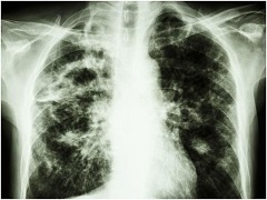 阿特珠单抗是小细胞肺癌的一线疗法