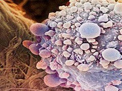 什么是输卵管癌？