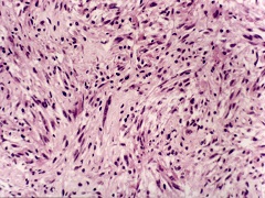 脑胶质母细胞瘤发病机制（二）