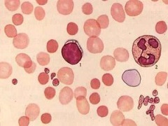 真性红细胞增多症有哪些危害和症状