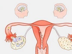 卵巢癌会引发哪些并发症？