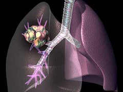 非小细胞肺癌的治疗方式