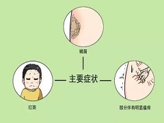 阿普斯特是用于斑块型银屑病的PDE4抑制剂