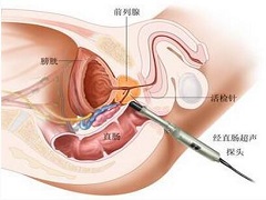 阿比特龙降低前列腺癌患者的复发率