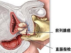 前列腺癌晚期还可以服用阿比特龙吗？