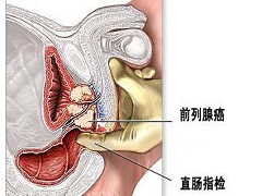 前列腺癌常见的治疗方法有哪些？