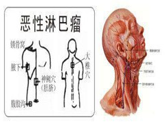 淋巴癌4大诱因有哪些