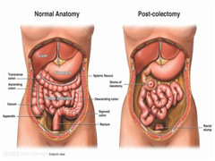 直肠癌的这些症状你一定要知道
