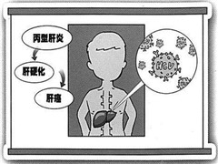 接吻会传染丙肝这是真的吗？